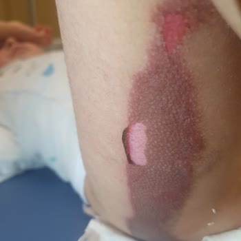 Çocuğumun Ameliyat Sonrası Batikon Yanığına Maruz Kalması Ve Hastane İhmalinden Kaynaklanan Mağduriyet