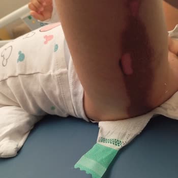 Çocuğumun Ameliyat Sonrası Batikon Yanığına Maruz Kalması Ve Hastane İhmalinden Kaynaklanan Mağduriyet