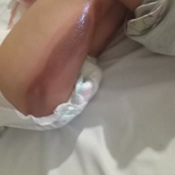 Çocuğumun Ameliyat Sonrası Batikon Yanığına Maruz Kalması Ve Hastane İhmalinden Kaynaklanan Mağduriyet