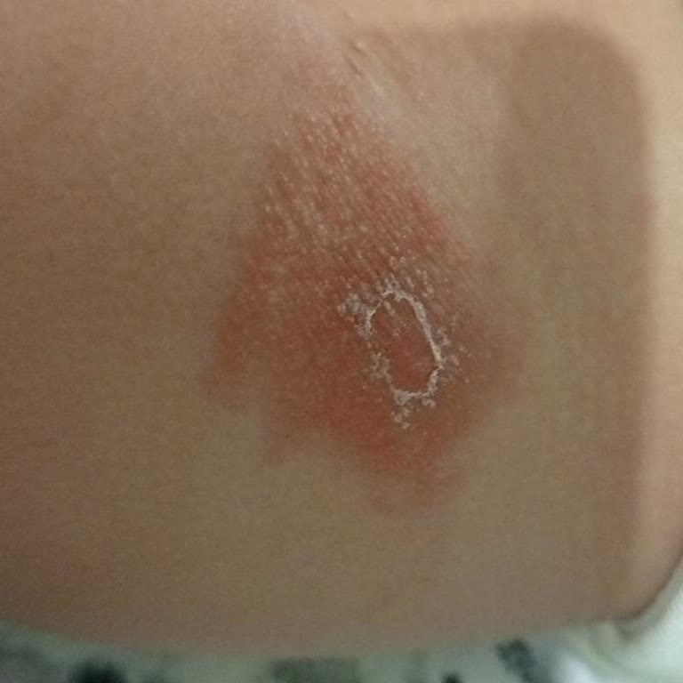 Molfix Bebek Bezi Ciltte Ciddi Sorunlara Yol Açtı, Mağduriyet Yaşadık