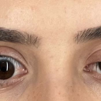 Dr. Hakan Genç Botoks İşlemi Sonrası Güvenlik Ve Sonuçlarla İlgili Ciddi Endişeler Yaşadık!