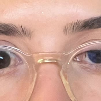 Dr. Hakan Genç Botoks İşlemi Sonrası Güvenlik Ve Sonuçlarla İlgili Ciddi Endişeler Yaşadık!