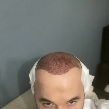 İsveç Klinik İki Kez Saç Ekimi Sonrası Hayal Kırıklığı ve Mağduriyet Yaşadım