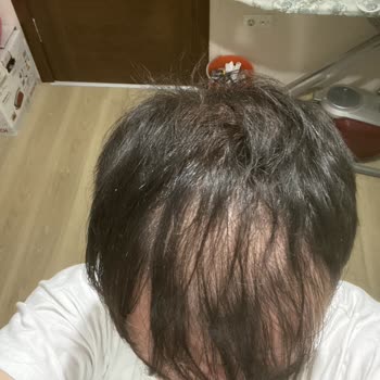 İsveç Klinik İki Kez Saç Ekimi Sonrası Hayal Kırıklığı ve Mağduriyet Yaşadım