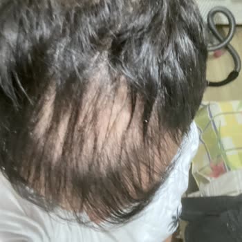 İsveç Klinik İki Kez Saç Ekimi Sonrası Hayal Kırıklığı ve Mağduriyet Yaşadım