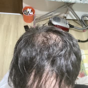 İsveç Klinik İki Kez Saç Ekimi Sonrası Hayal Kırıklığı ve Mağduriyet Yaşadım