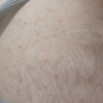 Tüy Dökücü Krem Sonrası Ciddi Cilt Reaksiyonu Yaşadım