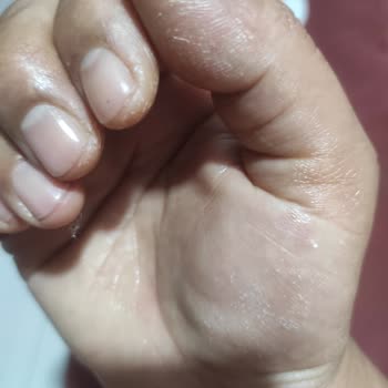 Domol Leke Çıkarıcı Ciltte Yanık Oluşturdu, Ambalajda Uyarı Yok!