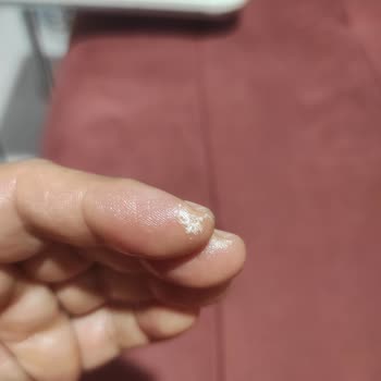 Domol Leke Çıkarıcı Ciltte Yanık Oluşturdu, Ambalajda Uyarı Yok!