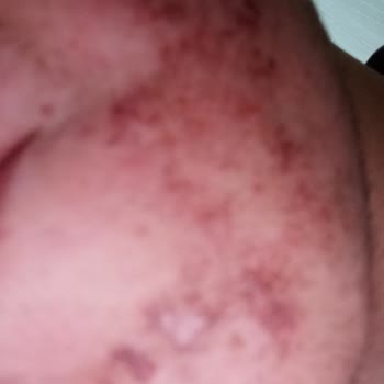 BİM’den Aldığım Saç Boyası Şiddetli Alerjiye Sebep Oldu