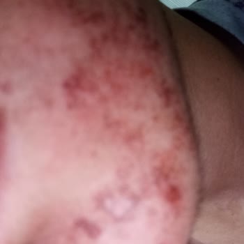 BİM’den Aldığım Saç Boyası Şiddetli Alerjiye Sebep Oldu