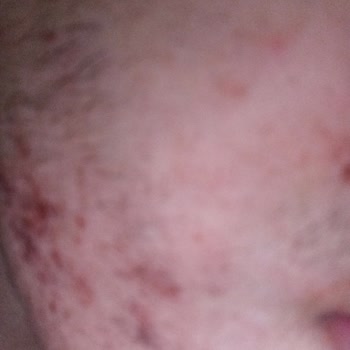 BİM’den Aldığım Saç Boyası Şiddetli Alerjiye Sebep Oldu