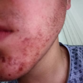 BİM’den Aldığım Saç Boyası Şiddetli Alerjiye Sebep Oldu