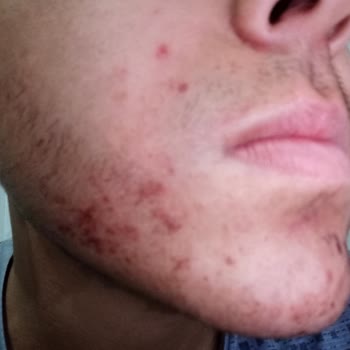 BİM’den Aldığım Saç Boyası Şiddetli Alerjiye Sebep Oldu