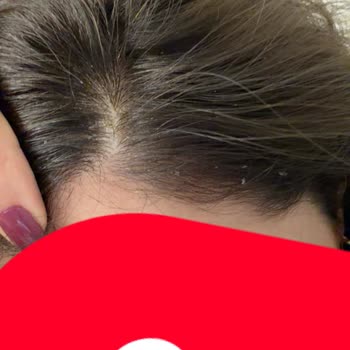 Saç Boyası İşlemi Sonrası Yaşadığım Mağduriyet Ve Geri Dönüşü Olmayan Zarar