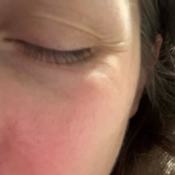 Nivea Jel Krem Cildimde Şiddetli Yanma Ve Tahrişe Sebep Oldu!