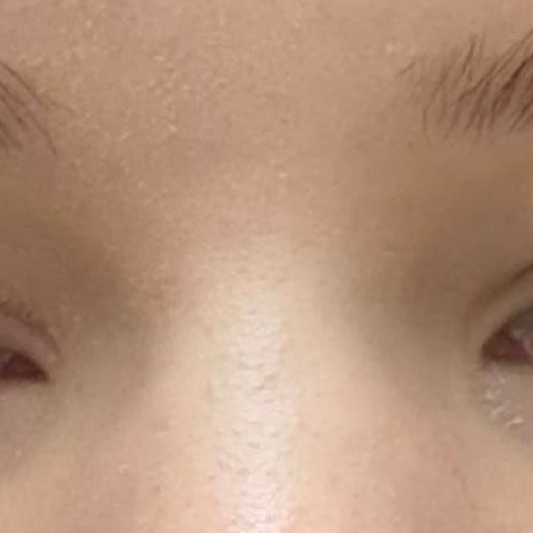 Flormar Skin Lifting Fondöten Ciddi Alerjik Reaksiyona Sebep Oldu, İade Ve Hak Talebim Var