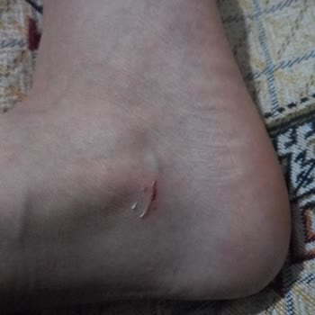 İlk Kullanımda Yaralanmaya Sebep Olan Ayakkabıda Değişim Talebi Ve Mağaza Yaklaşımı