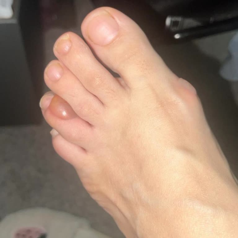 Bantlı Crocs Terlik Mekke’de Ciddi Ayak Yaralanmalarına Neden Oldu Orijinalliğinden Şüpheliyim