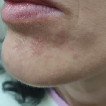 Sephora’dan Aldığım Serum Cildimde Ciddi Tahrişe Yol Açtı, İade Veya Değişim İstiyorum