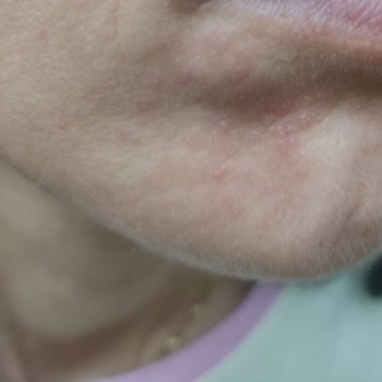 Sephora’dan Aldığım Serum Cildimde Ciddi Tahrişe Yol Açtı, İade Veya Değişim İstiyorum