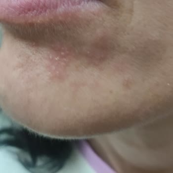 Sephora’dan Aldığım Serum Cildimde Ciddi Tahrişe Yol Açtı, İade Veya Değişim İstiyorum