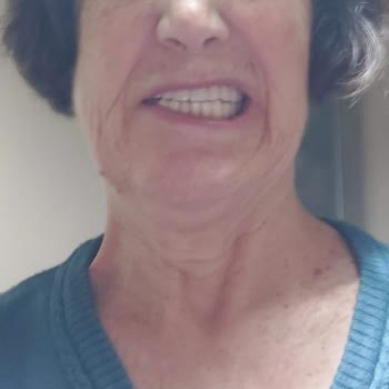 Yüz Felci Sonrası Klinik İlgisizliği Ve Ücret İadesi Talebi