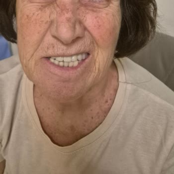 Yüz Felci Sonrası Klinik İlgisizliği Ve Ücret İadesi Talebi