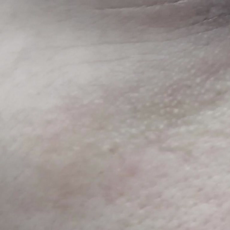 Yves Rocher Göz Kreminin Alerjik Reaksiyonu Ve İade Talebi