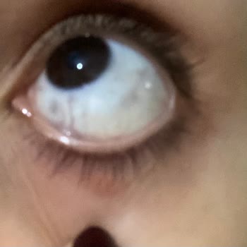 Estée Lauder Setinde Alerjik Reaksiyon Ve Para İadesi Talebi