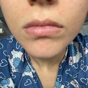 Nivea Aqua Rose Micellar Suyu Cildimde Şiddetli Yanma Ve Kızarıklığa Yol Açtı