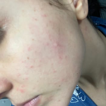 Nivea Aqua Rose Micellar Suyu Cildimde Şiddetli Yanma Ve Kızarıklığa Yol Açtı