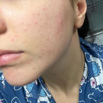 Nivea Aqua Rose Micellar Suyu Cildimde Şiddetli Yanma Ve Kızarıklığa Yol Açtı