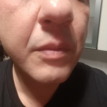 L'Oreal Revitalift X3 Kullanımından Sonra Göz Çevresinde Morarma Ve Şişlik