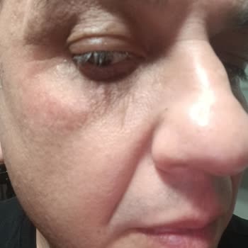 L'Oreal Revitalift X3 Kullanımından Sonra Göz Çevresinde Morarma Ve Şişlik