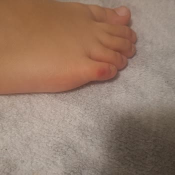 Çocuğumun Ayağını Tahriş Eden Skechers Ayakkabı İçin Değişim Talebi