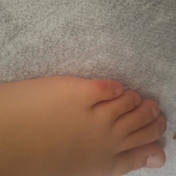 Çocuğumun Ayağını Tahriş Eden Skechers Ayakkabı İçin Değişim Talebi