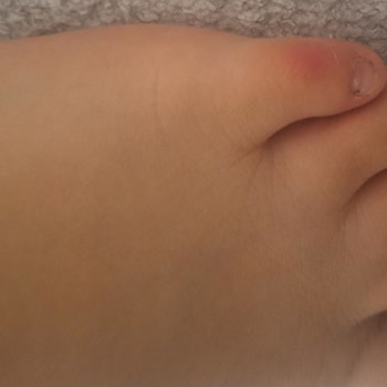 Çocuğumun Ayağını Tahriş Eden Skechers Ayakkabı İçin Değişim Talebi