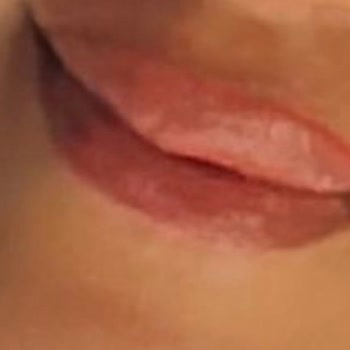 Dudak Dolgu İşlemi Sonrası Asimetri Ve Klinik İletişimsizliği