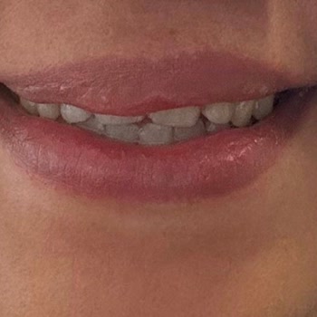 Dudak Dolgu İşlemi Sonrası Asimetri Ve Klinik İletişimsizliği