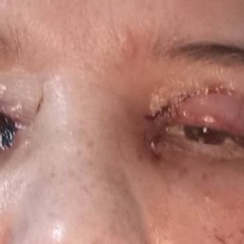 Başarısız Göz Kapağı Estetiği Kalıcı İzler Ve Psikolojik Yıpranma