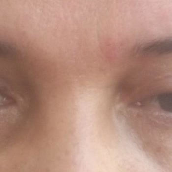 Başarısız Göz Kapağı Estetiği Kalıcı İzler Ve Psikolojik Yıpranma