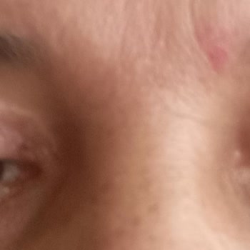 Başarısız Göz Kapağı Estetiği Kalıcı İzler Ve Psikolojik Yıpranma