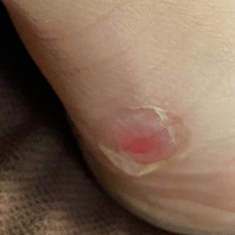 Sert Topuk Bölgesi Derin Yaralar Açıyor, Ayakkabı Değişimi Talep Ediliyor