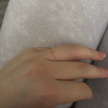 Pandora Yüzüğünde Alerjik Reaksiyon, Sağlık Sorunu Ve İade Talebi