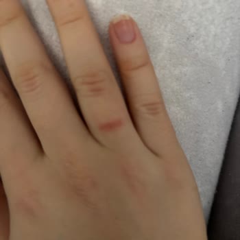Pandora Ring Causing Allergic Reaction Redness And Sores