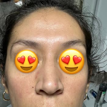 Caudalie Vinoperfect Serum Caused Breakouts After Regular Use