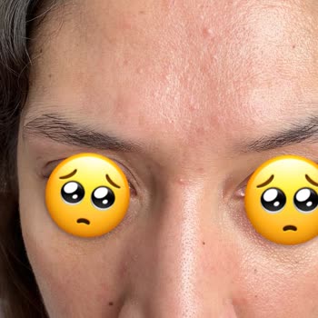 Caudalie Vinoperfect Serum Caused Breakouts After Regular Use