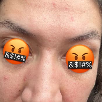 Caudalie Vinoperfect Serum Caused Breakouts After Regular Use