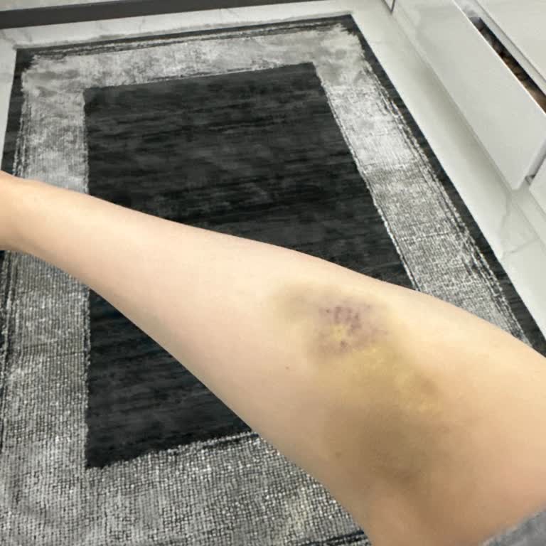 A Life Hospital Hijyen Kurallarını İhlal Eden Personel Nedeniyle Damar Yolu Ve Kanama Sorunu